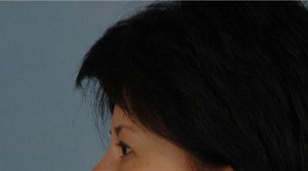 45-54 year old woman treated with Asian Eyelid Surgery before 3615826