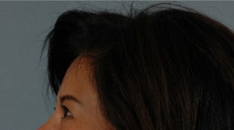45-54 year old woman treated with Asian Eyelid Surgery after 3615826