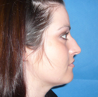 Rhinoplasty before 1357429