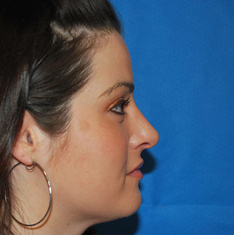 Rhinoplasty after 1357429