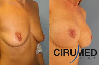 Supercharged breast augmentation (fat transfer/silicone) 1125122