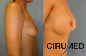 Supercharged breast augmentation (fat transfer/silicone) before 1125122