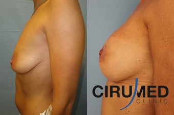 Supercharged breast augmentation (fat transfer/silicone) 1125122