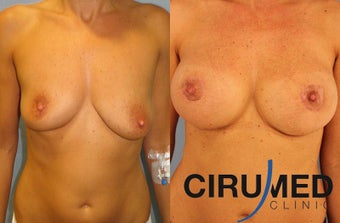 Supercharged breast augmentation (fat transfer/silicone) after 1125122