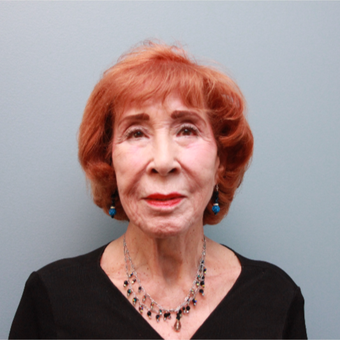 83 year old woman treated with the LiftLift ® which is similar to the MACS Facelift before 3544521