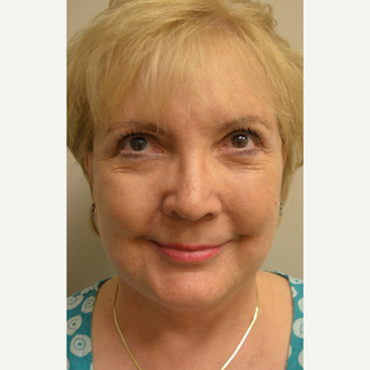 65-74 year old woman treated with Facelift, Neck Liposuction, Browlift, Upper & Lower Blepharoplasty after 3371382