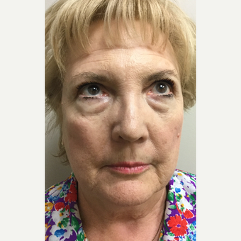 65-74 year old woman treated with Facelift, Neck Liposuction, Browlift, Upper & Lower Blepharoplasty before 3371382