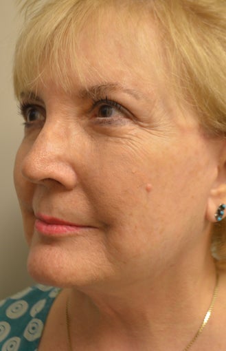 65-74 year old woman treated with Facelift, Neck Liposuction, Browlift, Upper & Lower Blepharoplasty 3371382
