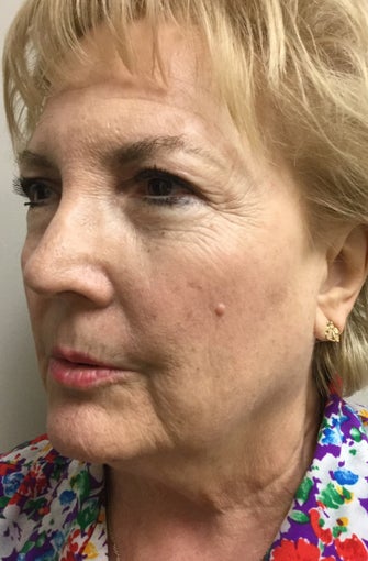 65-74 year old woman treated with Facelift, Neck Liposuction, Browlift, Upper & Lower Blepharoplasty 3371382