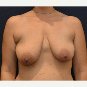 35-44 year old woman treated with Breast Lift with Implants before 3726925