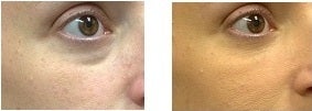 Treatment of Tear Troughs and Under Eye Circles with Restylane Filler before 770956