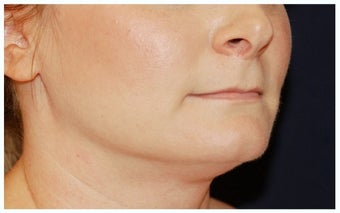 Chin Liposuction before 1256368