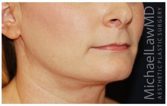 Chin Liposuction after 1256368