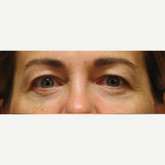 Eyelid Surgery before 3123630