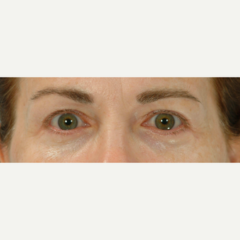 Eyelid Surgery after 3123630