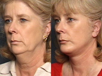 Chin Implant, Brow Lift, Facelift & Lower Eyelid Surgery 338485