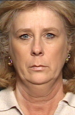 Chin Implant, Brow Lift, Facelift & Lower Eyelid Surgery before 338485