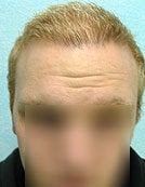 FUE – BHT by SFET Using Head and Body Hair 3,000 graft hairline and scalp after 196025