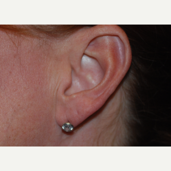 35-44 year old woman treated with Restylane for ear lobe correction. before 3629435