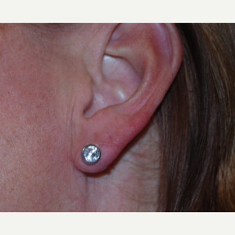 35-44 year old woman treated with Restylane for ear lobe correction. after 3629435