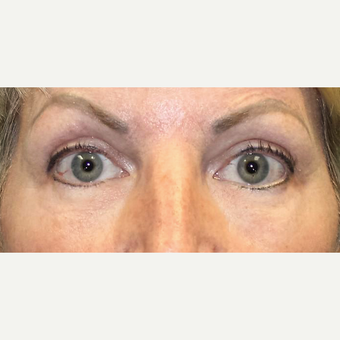 45-54 year old woman treated with Eyelid Surgery after 3286779
