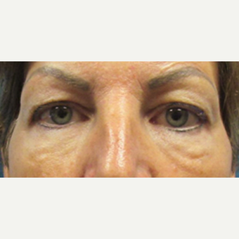 45-54 year old woman treated with Eyelid Surgery before 3286779
