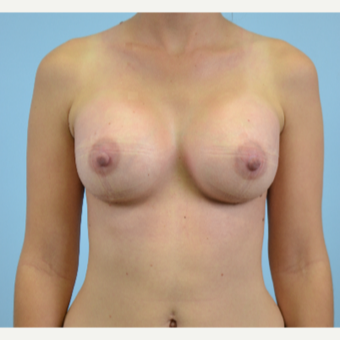 25 year old woman treated with Breast Augmentation after 3432320