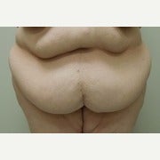 45-54 year old woman treated with Tummy Tuck before 2436894