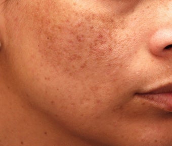 Cosmelan for Pigmentation before 110225
