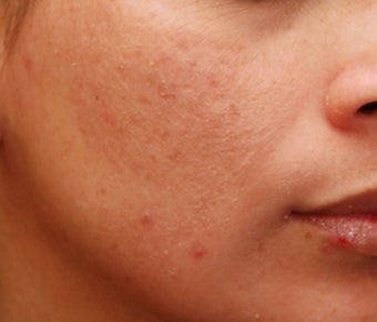 Cosmelan for Pigmentation after 110225