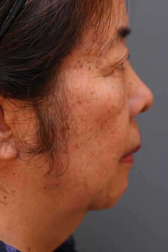 Female Chin Implant before 887064