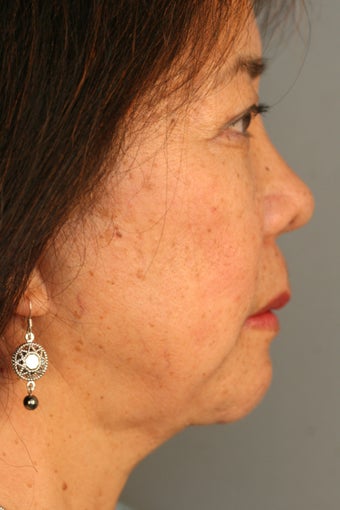 Female Chin Implant after 887064