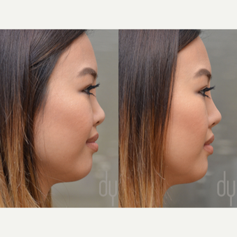 Non Surgical Rhinoplasty before 3322526