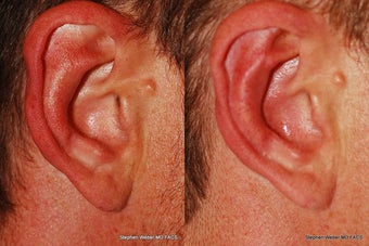 Ear Surgery before 1445743