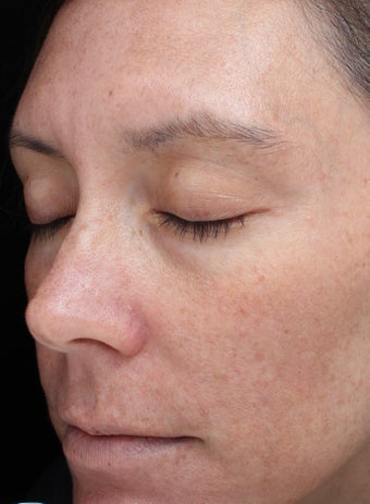 39 year old woman with melasma treated with Halo Laser 3656479