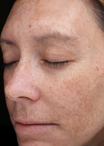 39 year old woman with melasma treated with Halo Laser 3656479