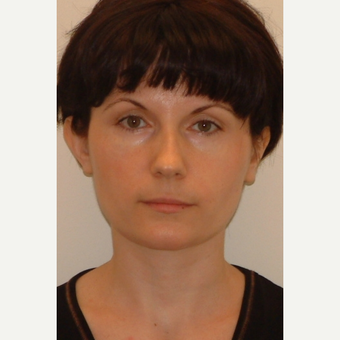 25-34 year old woman treated with Ear Surgery before 3259142