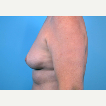 35-44 year old woman treated with Breast Implants before 3440898