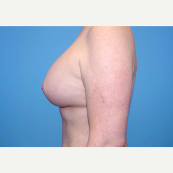35-44 year old woman treated with Breast Implants after 3440898