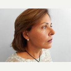 55-64 year old woman treated with Facelift after 3500880