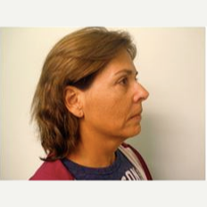 55-64 year old woman treated with Facelift before 3500880
