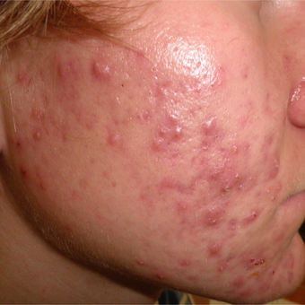Acne can be cured with proper treatments. before 3703805