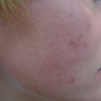 Acne can be cured with proper treatments. after 3703805