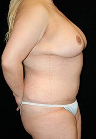 Breast Reduction and Tummy Tuck after 960984