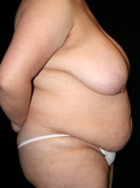 Breast Reduction and Tummy Tuck before 960984