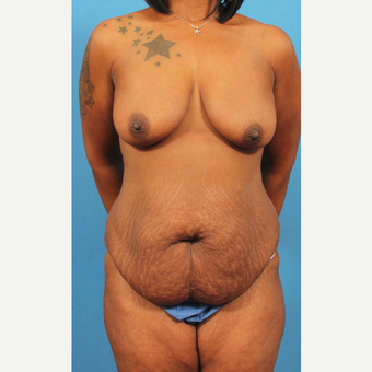 35-44 year old woman treated with Mommy Makeover before 3787069