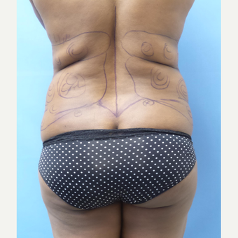 35-44 year old woman treated with Liposuction before 3168471
