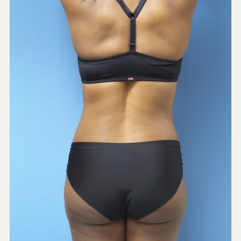 35-44 year old woman treated with Liposuction after 3168471