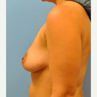 37 year old woman, Augmentation and circumareolar mastoexy, 425 cc filled to 450 cc before 3543311