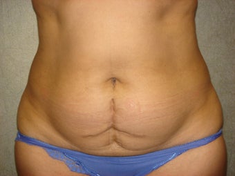 C.L.A.S.S ® Tummy Tuck before 926779